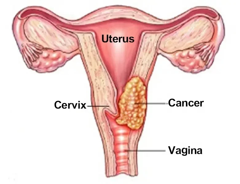 How Hormone Therapy Slows the Growth of Uterine Cancer Cells