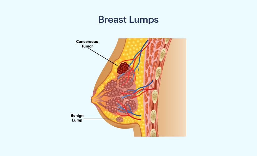New Breast Lump