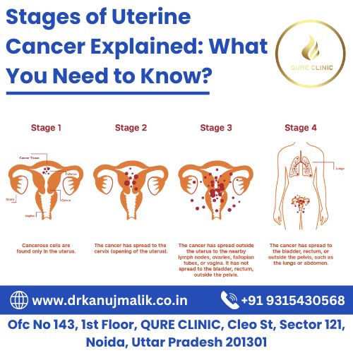 Stages of uterine cancer explained
