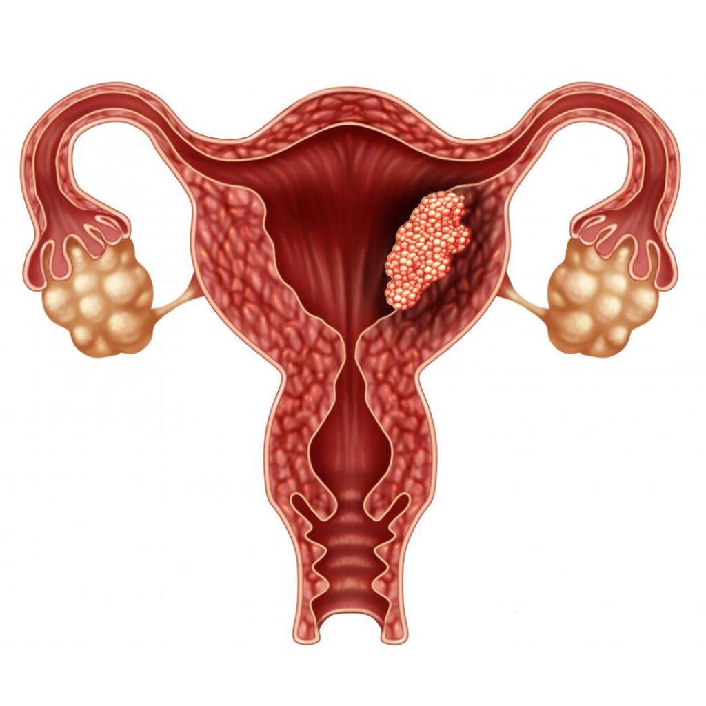 Difference Between Uterine Cancer and Ovarian Cancer