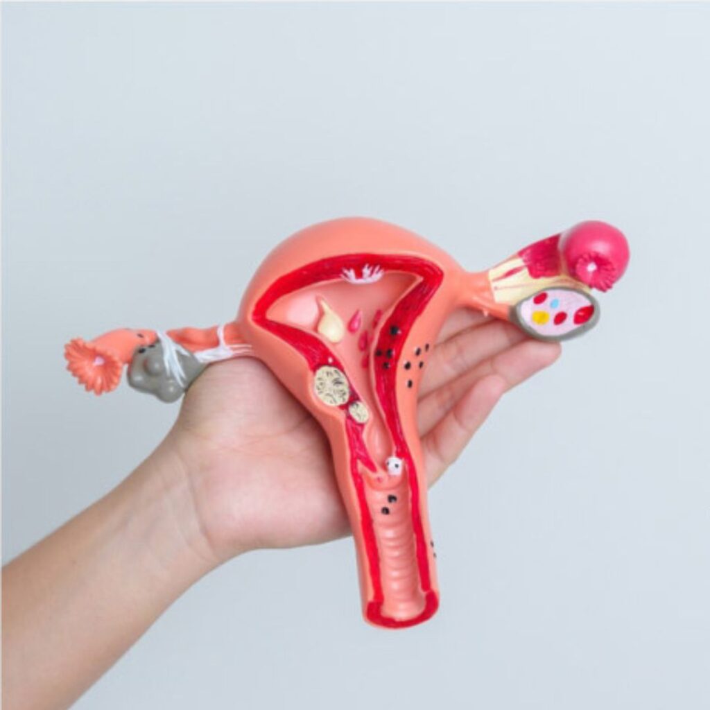 Endometrial Cancer: Risk Factors and Early Detection