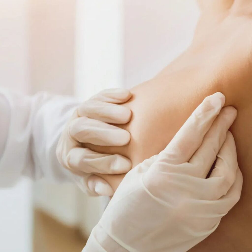 Understanding Paget’s Disease of the Breast